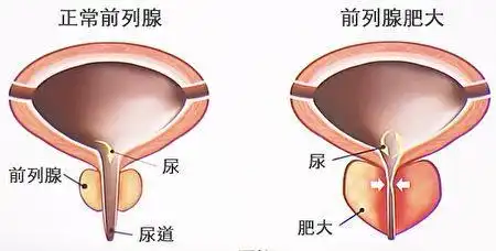 男科医生王合章对前列腺炎认识的十大误区