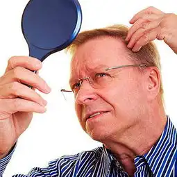 男人会脱发的详细分析报告