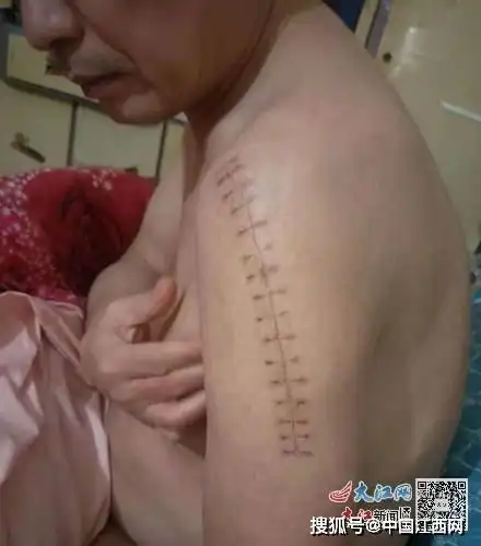 湖南男子因戴口罩被殴打骨折施暴者刑期由8个月改判三年半