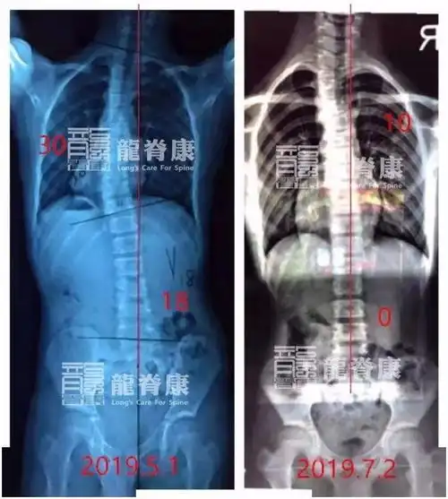12岁男孩治疗2个月后,脊柱侧弯度数从30减至10