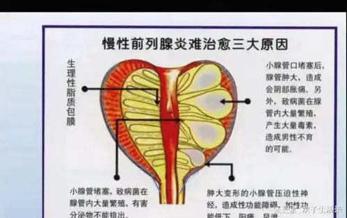 中医治疗前列腺炎,分析与药方