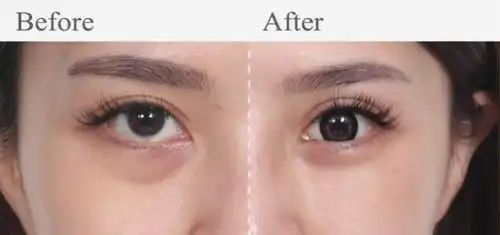 一张图告诉你卧蚕和眼袋的区别