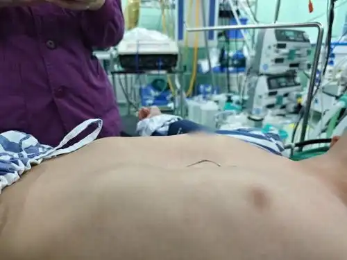 宁波12岁男孩胸口坍塌像漏斗医生这是病得尽早治