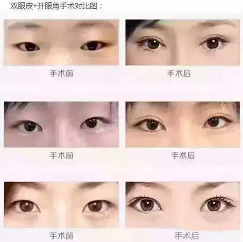纳米无痕双眼皮手术恢复过程图片