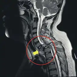 脊椎被吃掉一截台湾男童患罕见病瘫痪不治