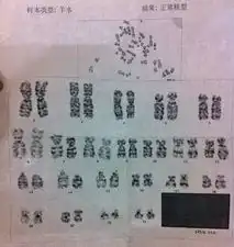同问染色体核型分析报告谁能看懂谢谢