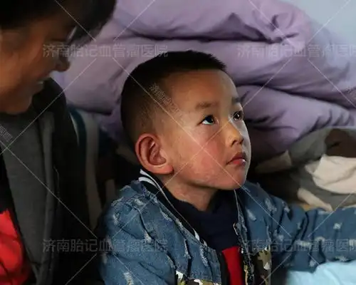 希望山东美丽圆梦高青县大面积青红胎记男孩获救助治疗