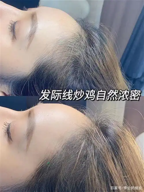 脱发人群年龄阶段下降,90后成为植发的主力消费人群