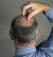 男人谢顶更不易得癌十个缺陷反而健康9