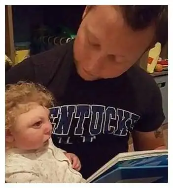 小男孩身患怪病,只有半个脑袋,在父母爱的陪伴下已经3岁