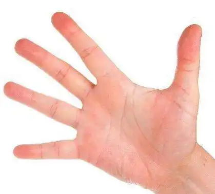 肝功能好的人,身体兴许没有1黄2痛3红