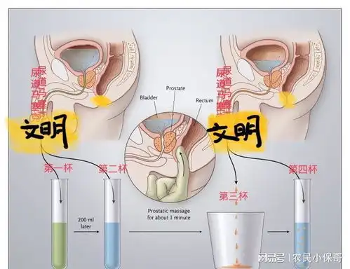 中医治疗慢性前列腺炎的药方解析