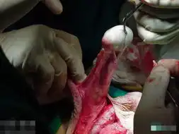 科普图片慎阅性感人妖变性手术过程