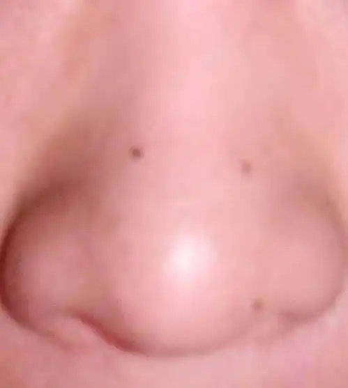 男鼻子上这三颗痣有会看面相的人给看看吗