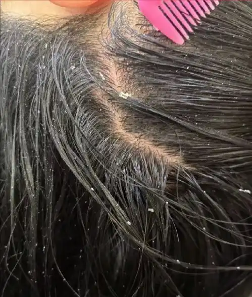 男生头痒,头皮屑像雪花飘一样怎么办皮肤科医生告诉你,男生去屑止痒只要三步无屑秀发让少年感溢出屏幕