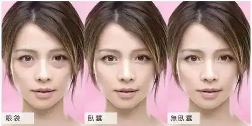 卧蚕,填多少剂量的玻尿酸才够