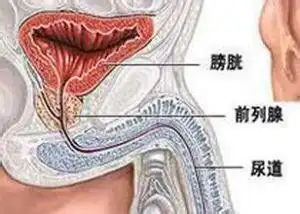 前列腺炎有哪些疗法