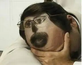 十种脱发症状大家对症分析,才能治疗