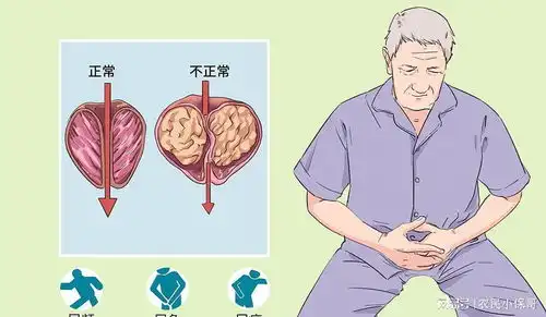 中医治疗慢性前列腺炎的药方解析