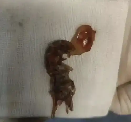 哭笑不得14岁小男孩将活龙虾塞入肛门,男孩想把小龙虾变成龙虾干