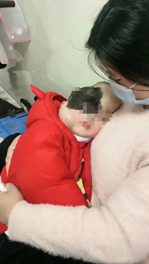 三岁男孩为治大片胎记埋入扩张器妈妈头上脸上鼓包越来越大活动睡觉都要看着