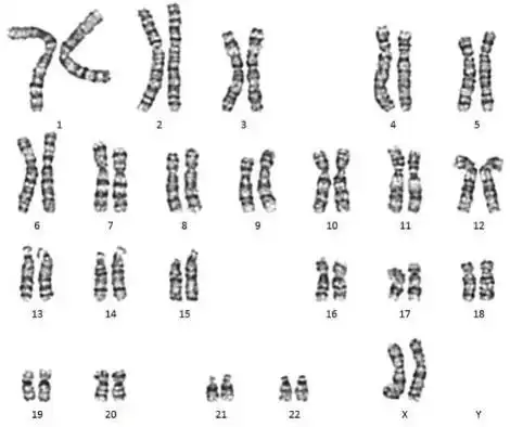 染色体检查怀宝宝的那些秘密都在这里