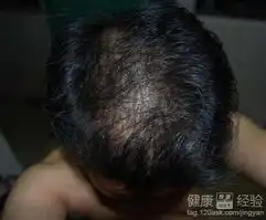 脱发都有什么危害