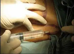 实拍泰国人妖变性手术全过程真的很痛