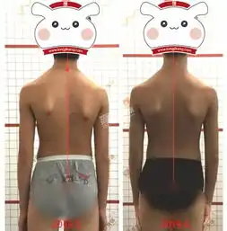 仅仅2个月,12岁男孩脊柱侧弯度数从30减至10