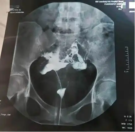 输卵管堵塞别慌张介入治疗来帮忙