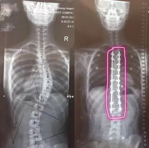宁海14岁女孩脊柱侧弯达32度,已发病好几年可半个月前学校的体检报告却显示正常