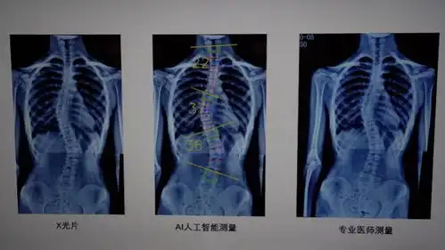 男孩脊柱侧弯83度,手术后长高6厘米专家称若治疗不当会加重
