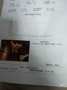 这样的输卵管是不是不通呢各位帮忙看下