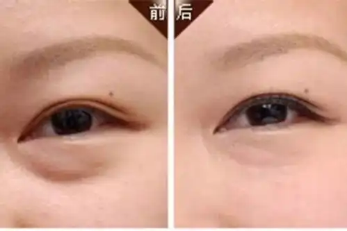 黑眼圈眼袋卧蚕,还在傻傻分不清