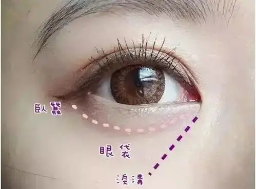 泪沟玻尿酸填充来解决