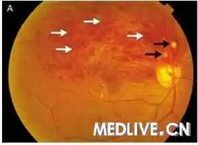 读片会69岁吸烟男性,右眼持续2周的急性视力丧失