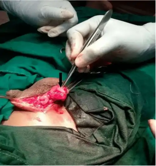 9岁男孩在河里游泳后,睾丸长满了密密麻麻的虫卵医生提醒这个病近期高发