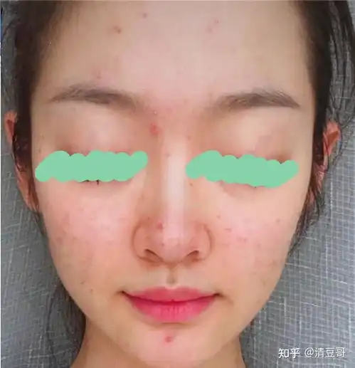 姑娘,奶茶喝多了会长痘