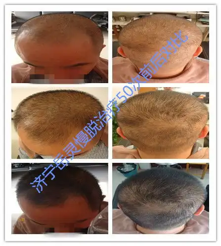 济宁治疗脱发医院男人性欲太强,脱发的风险可能更高