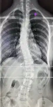 12岁男孩竟被查出脊柱侧凸,原因竟是很多大小朋友都在做的