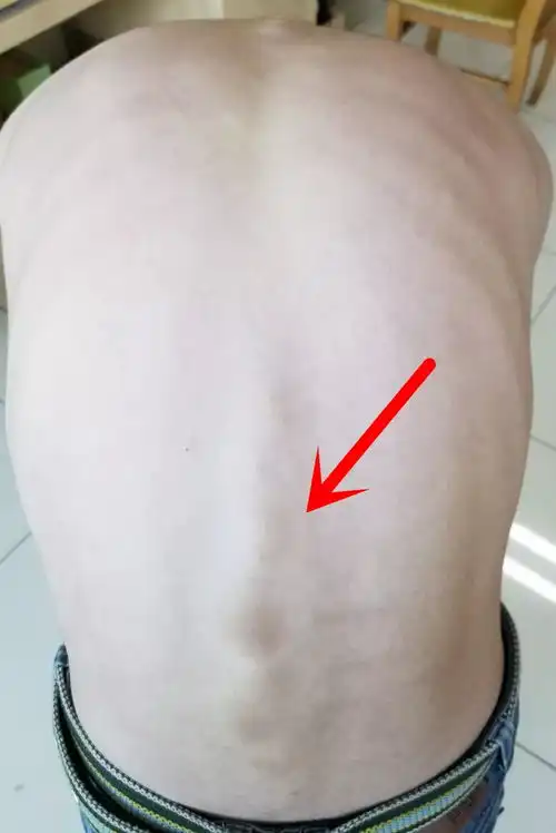 12岁男孩竟被查出脊柱侧凸,原因竟是很多大小朋友都在做的