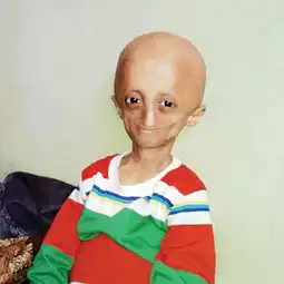 未老先衰印度14岁男孩患早衰症体重仅为25斤