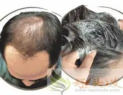 剖析九大脱发起因