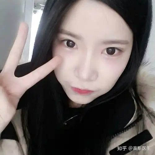 为什么好多单眼皮女孩要割双眼皮