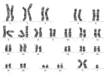 染色体核型分析在染色体病诊断中的应用