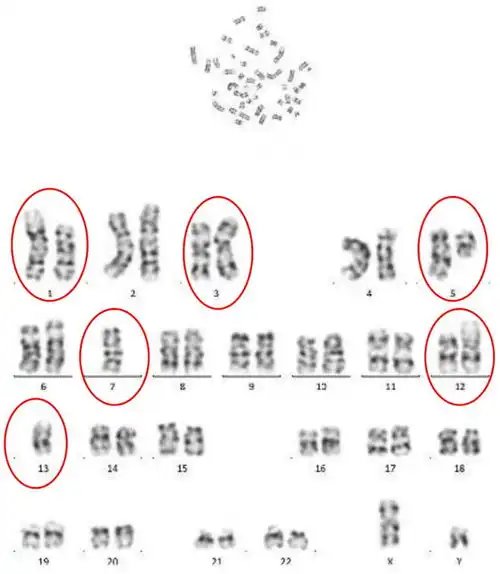 一例复杂核型mds伴vb12降低病例分享