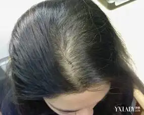 脂溢性脱发偏方大全医学专家详细分析脱发几大病因