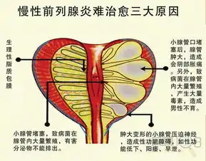 慢性前列腺炎影响性功能影响生育会变成前列腺癌告诉你真相