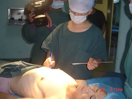 国内最大变性男子成功隆胸服雌激素10多年图