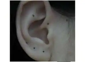 正常黑痣和黑色素瘤的区别